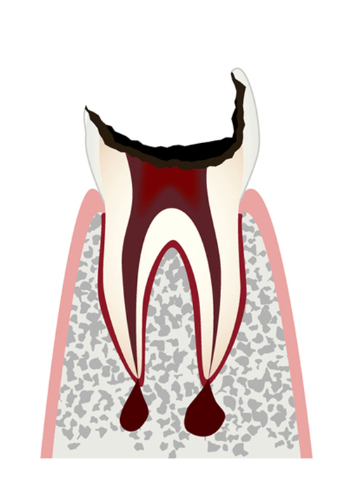 根の部分のみが残存している歯